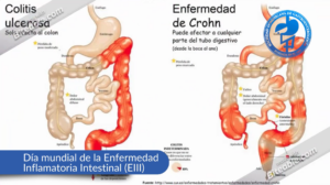 Read more about the article Día Mundial de la enfermedad inflamatoria intestinal